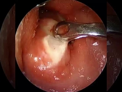 ρεύμα ≤ 1,5mA Αρθροσκόπηση ραδιοσυχνοτήτων πλάσμα ραβδί χειρουργικό εξοπλισμό ώμος ισχίο γόνατο