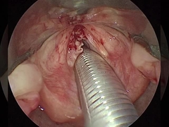 4 κανάλια ΟΡΤ Χειρουργικά όργανα με τυπικό ενεργό ηλεκτρόδιο τριπλού καλωδίου